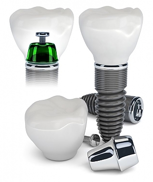 implant